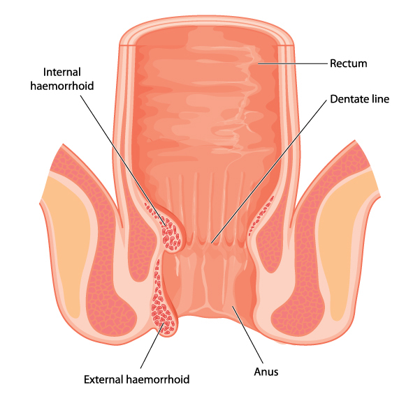 Laser treatment