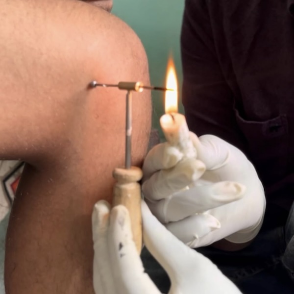 Agnikarma treatment