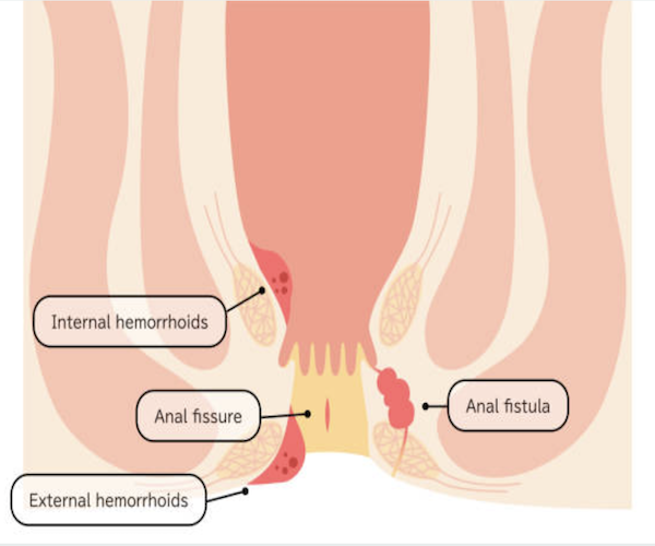 Anorectal Disorders