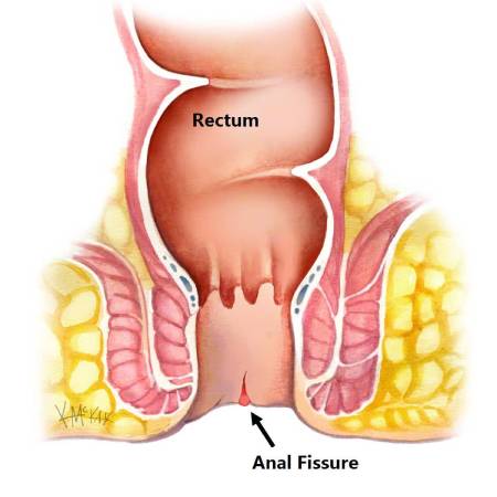 Anal Fissure treatment