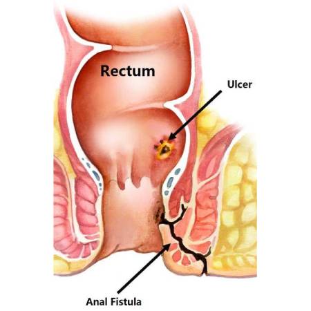 Anal Fistula treatment