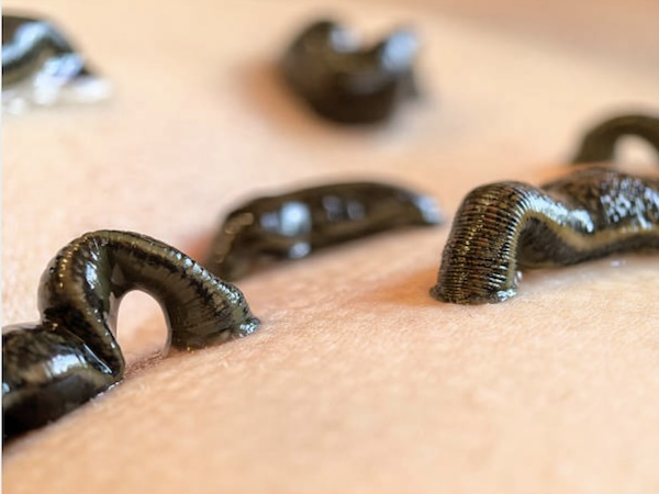 Leech Therapy