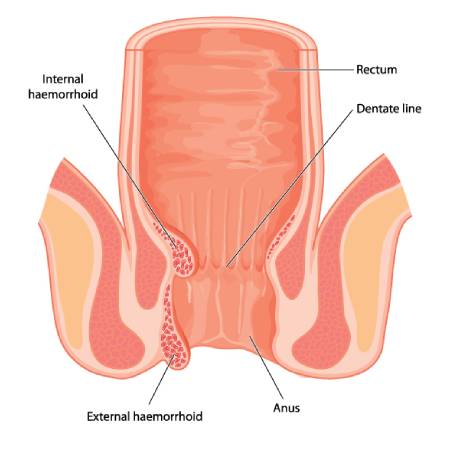 Piles treatment