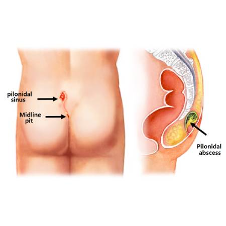 Pilonidal Sinus treatment