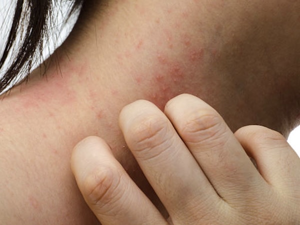 Psoriasis treatment