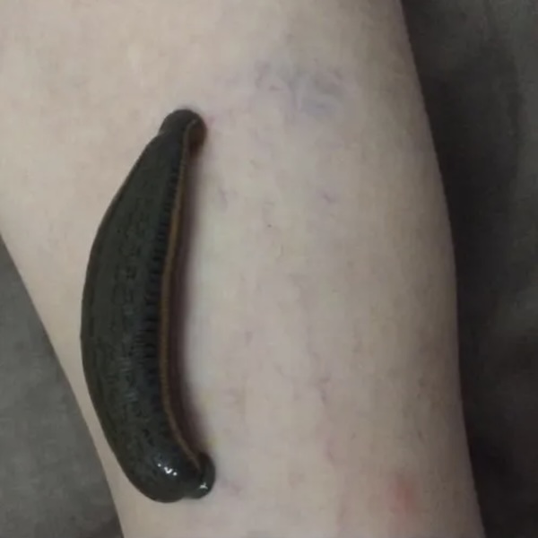 Raktamokshana treatment