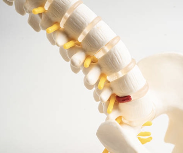Spondylitis treatment